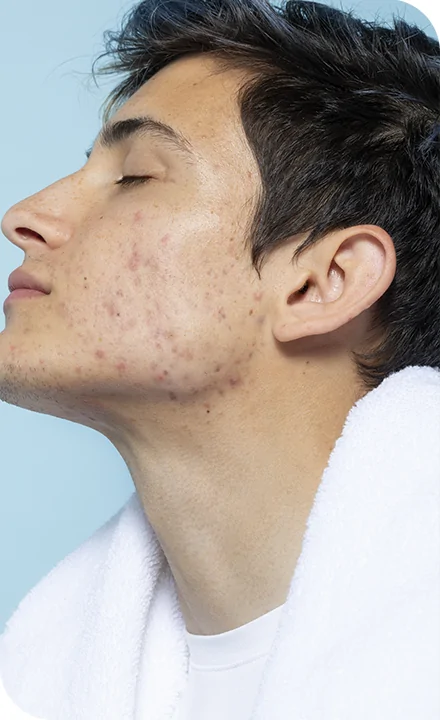 Acne